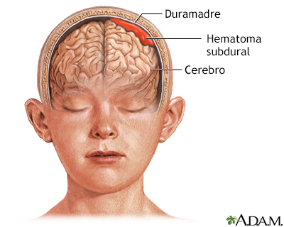 Hematoma subdural