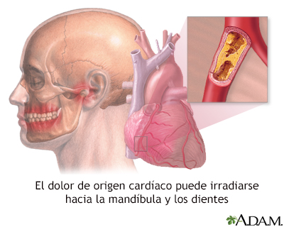 Dolor de mandíbula y ataques cardíacos