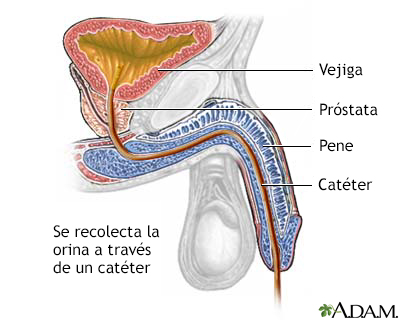 Cateterización