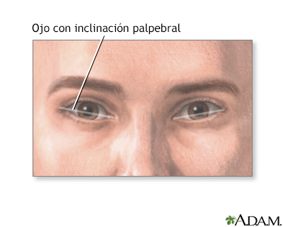 Inclinación palpebral