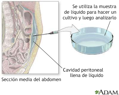 Cultivo peritoneal