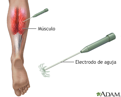 Electromiografía