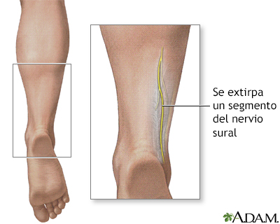 Biopsia de nervio