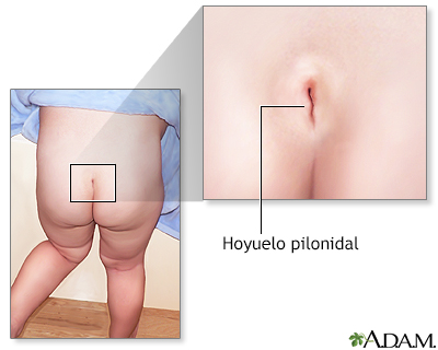 Fóvea pilonidal