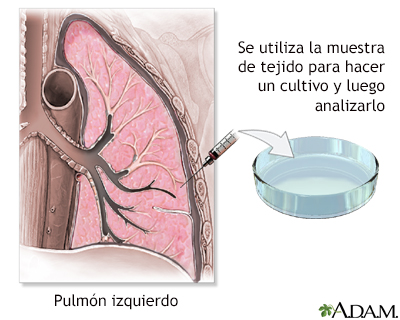 Cultivo pleural