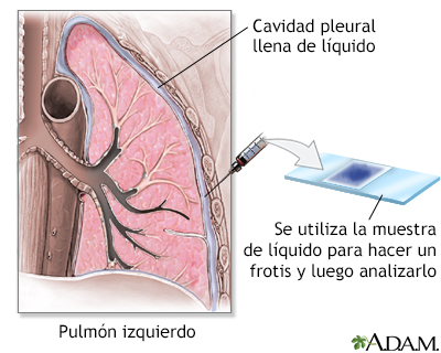 Frotis de pleura