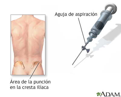 Biopsia de hueso