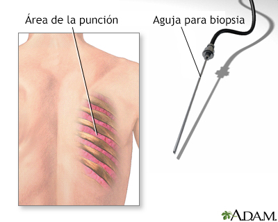 Biopsia de pulmón