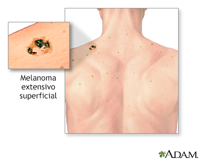 Melanoma