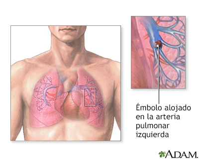 Émbolo pulmonar