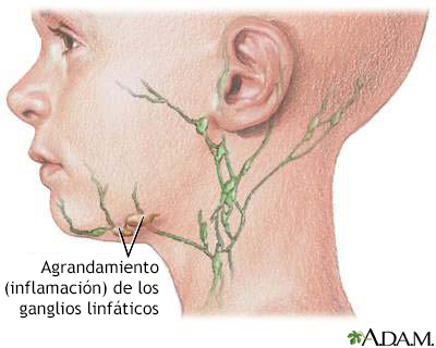 Nódulos linfáticos inflamados