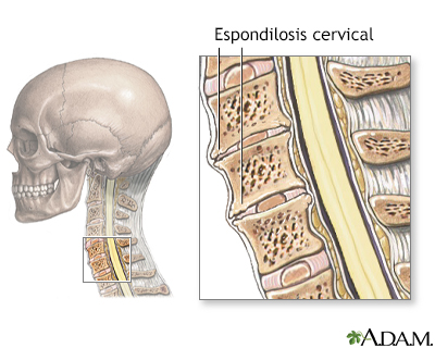 Espondilosis cervical