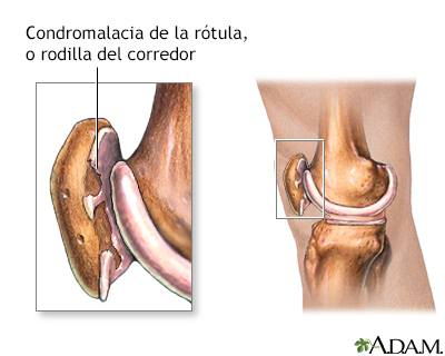 Rodilla de corredor