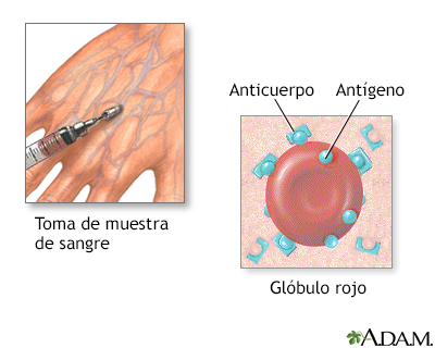 Prueba de sangre para herpes