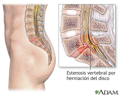 Estenosis espinal