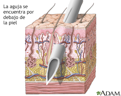 Capas de la piel y agujas