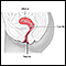 Displasia cervical - serie