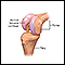 Reemplazo parcial de rodilla - serie