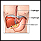 Reparación quirúrgica de una hernia hiatal - serie